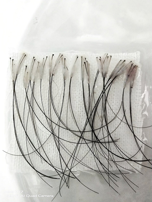 Пересадка длинных волос